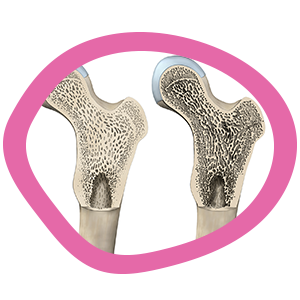 Bone health webinar