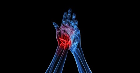 Artritis y dolor articular