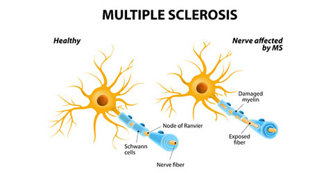 Esclerosis múltiple y nutrición basada en plantas